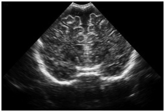 Медицинский снимок НСГ мозга ребенка