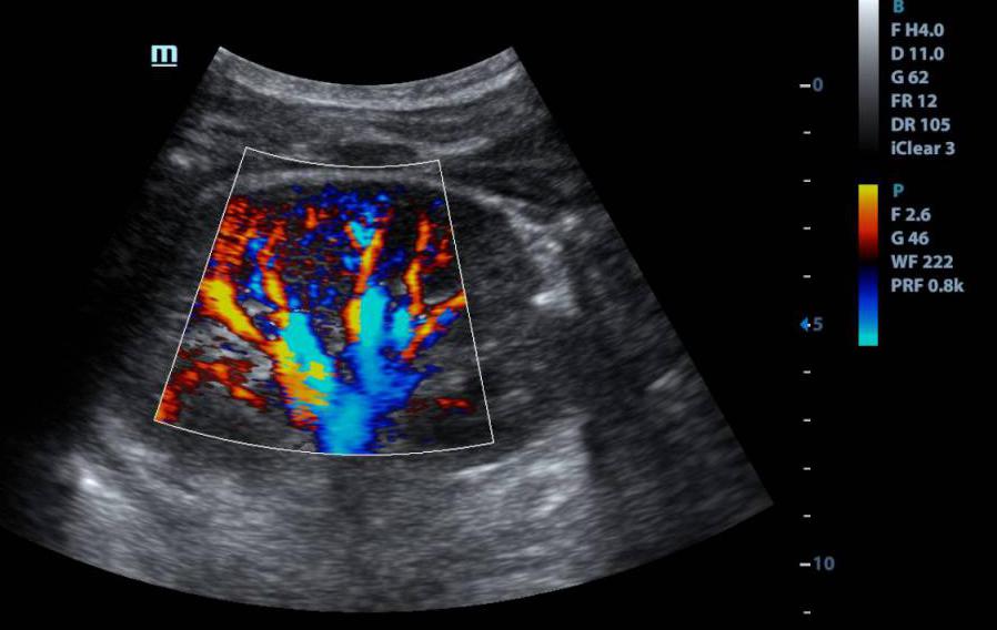 Снимок НСГ с кровоизлиянием