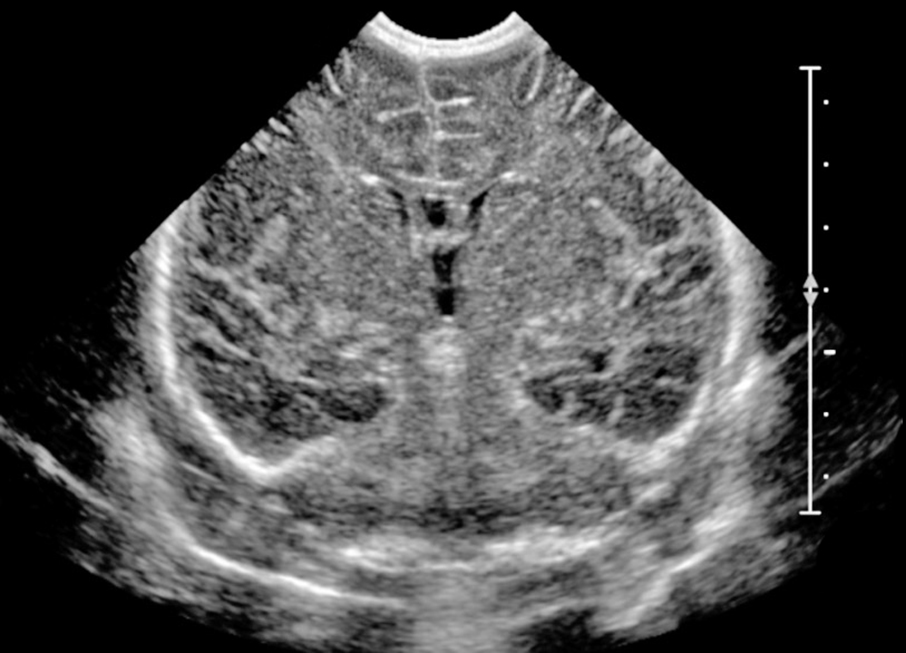 Неочевидные предвестники РАС: о чём говорит НСГ